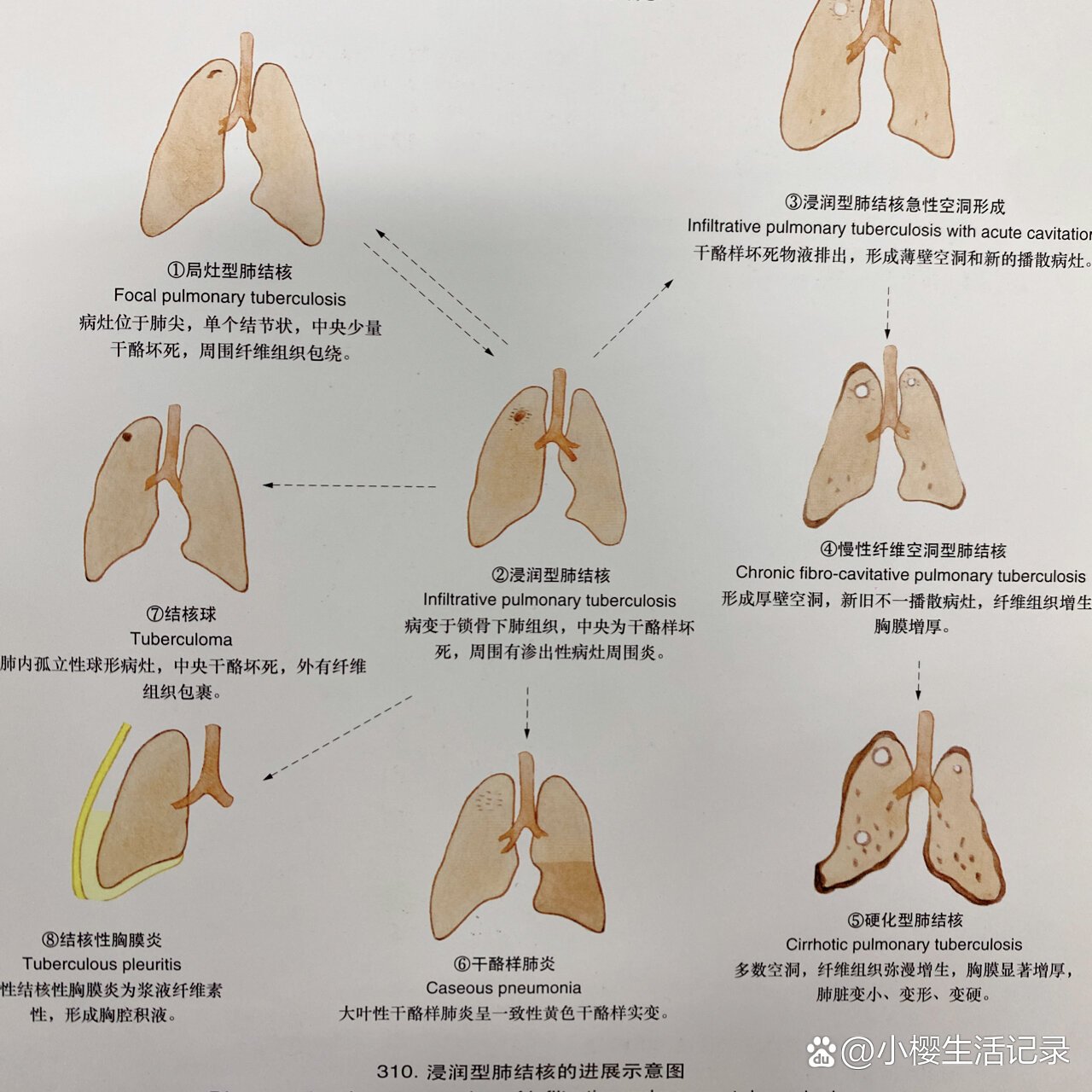 浸润性肺结核进展示意图