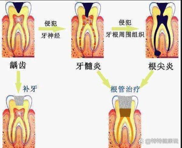 牙髓炎的症状和预防措施