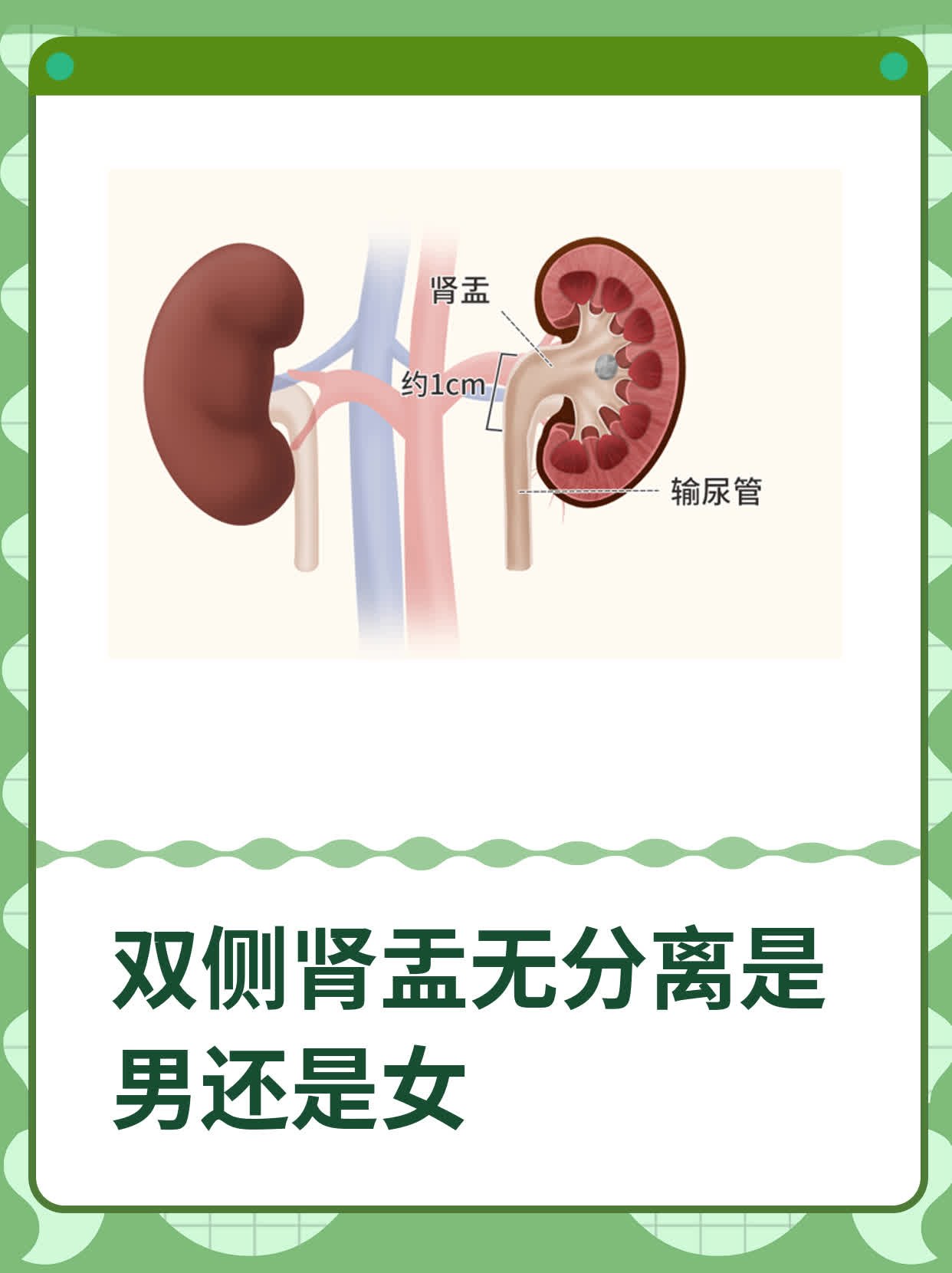 双侧肾盂无分离是男还是女