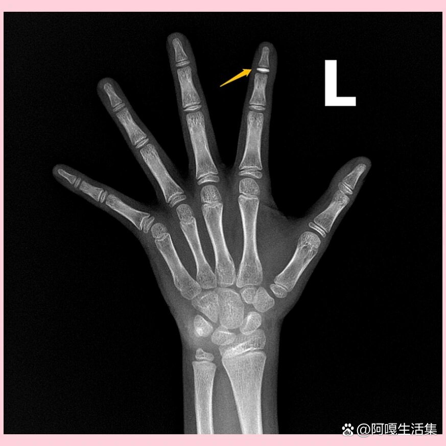 骨龄发现的象牙98骨骺-手腕关节x线