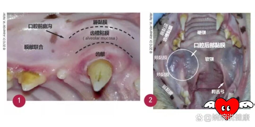 前庭沟溃疡图片