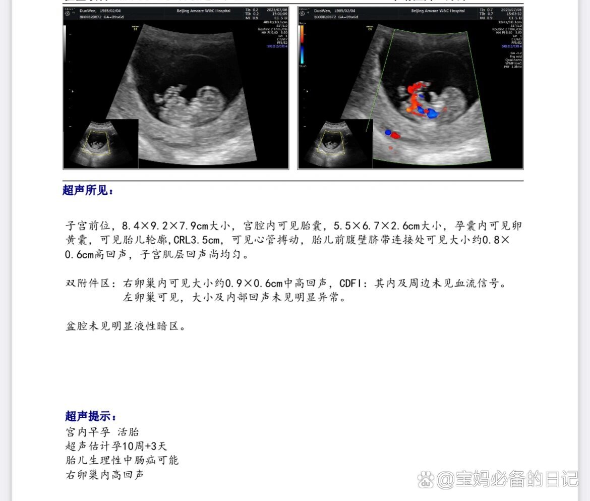 病理性缩复环超声图片图片