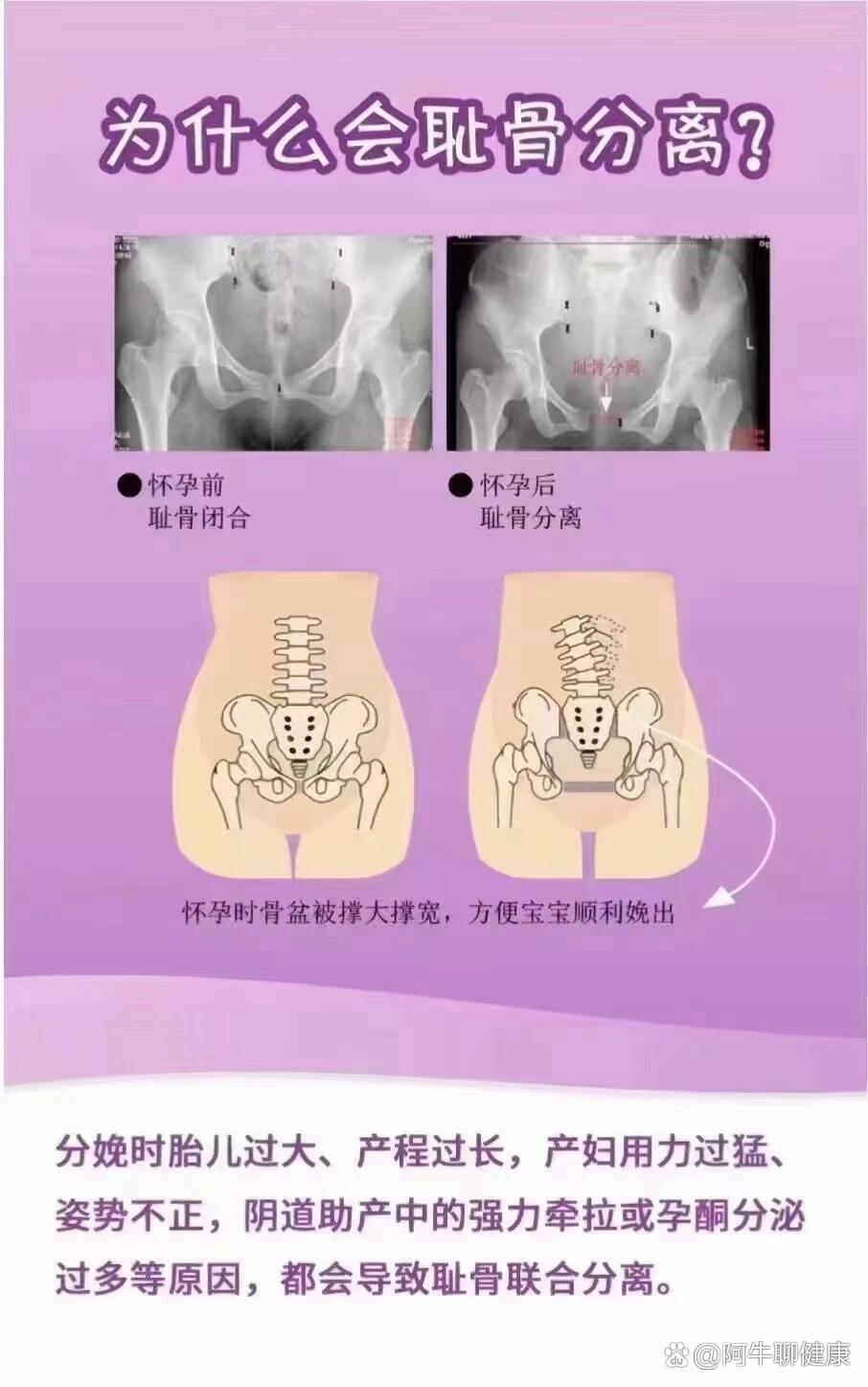 耻骨联合是什么图片