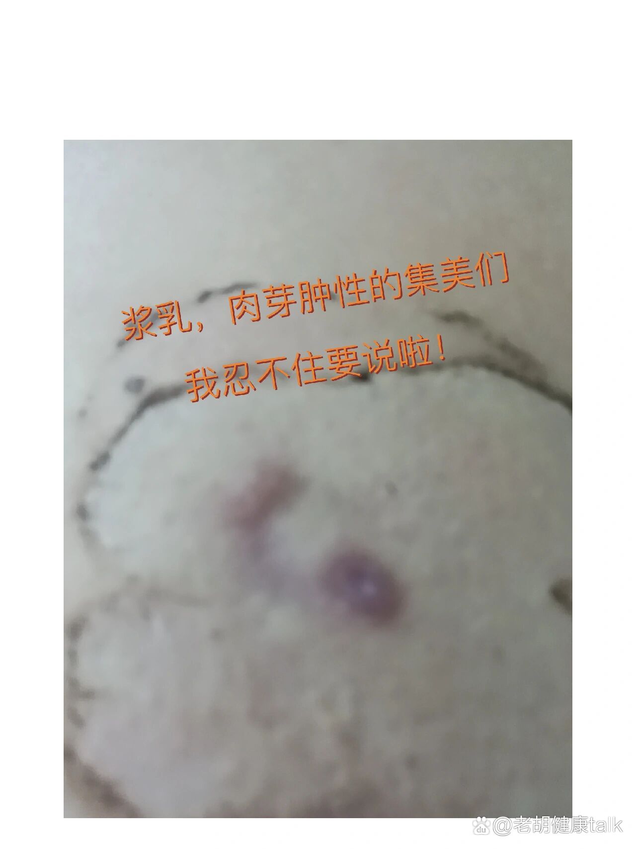 浆乳肉芽肿性乳腺炎图片