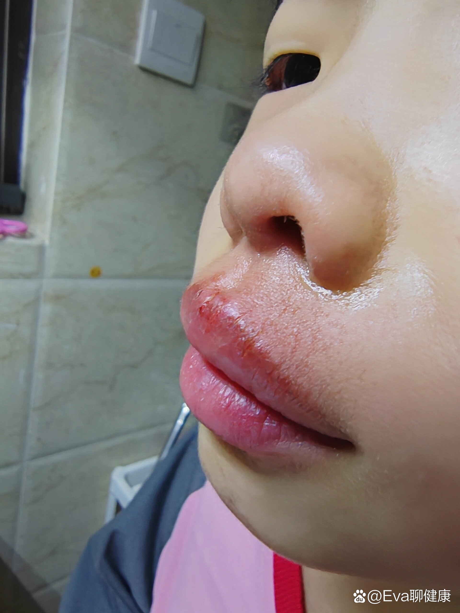 求问求问:孩子之前流鼻涕,把人中的皮肤擦红了,我用了红霉素软膏,但是