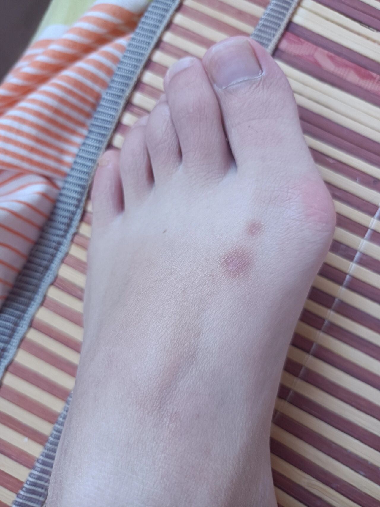 脚上长了一年的腱鞘囊肿消下去啦