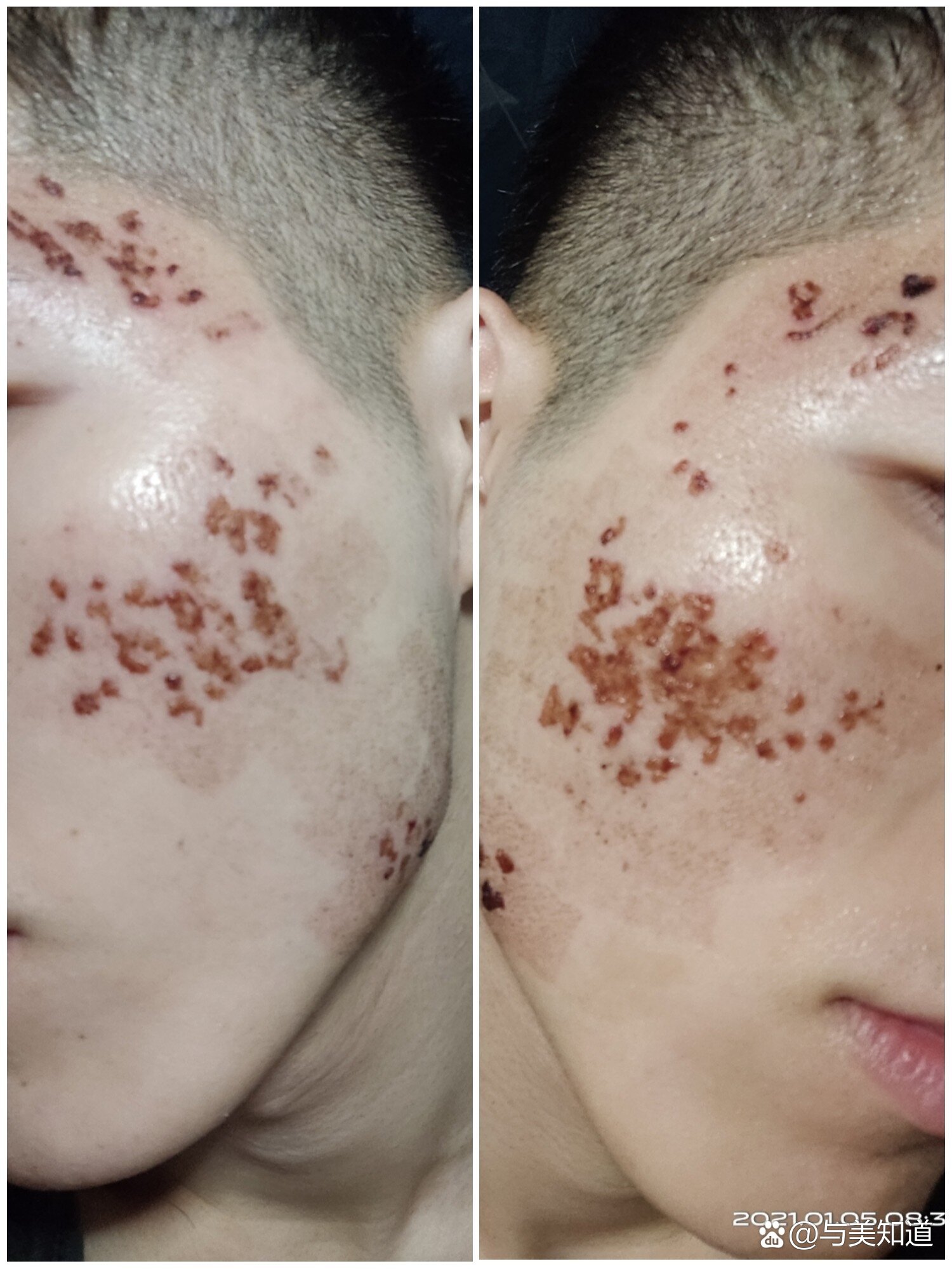 点阵激光术后十一天内变化