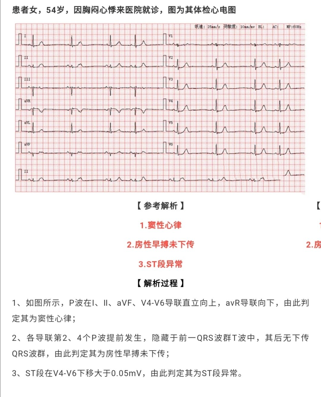 房性早搏未下传图片图片