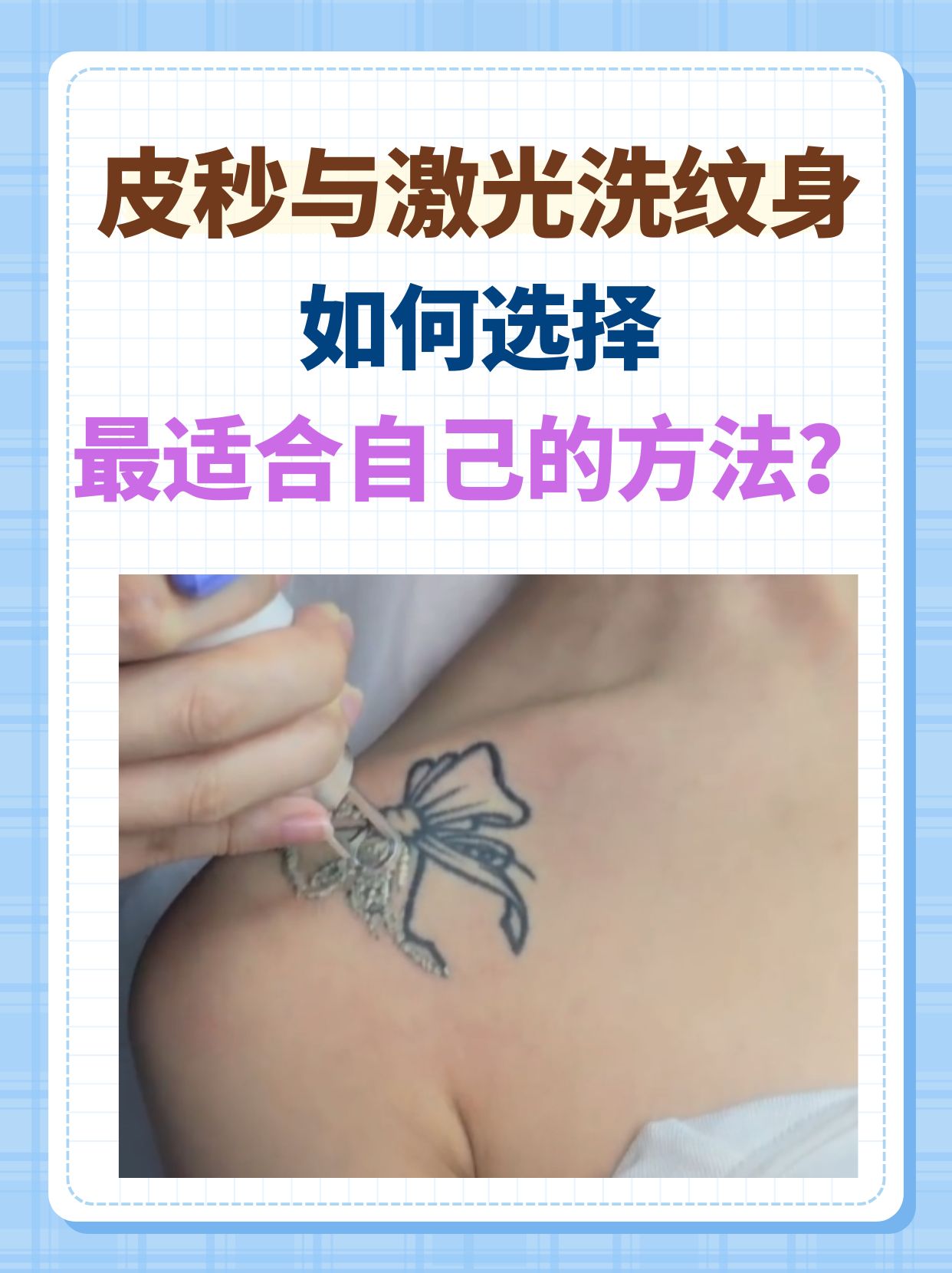 皮秒与激光洗纹身:如何选择最适合自己的方法?