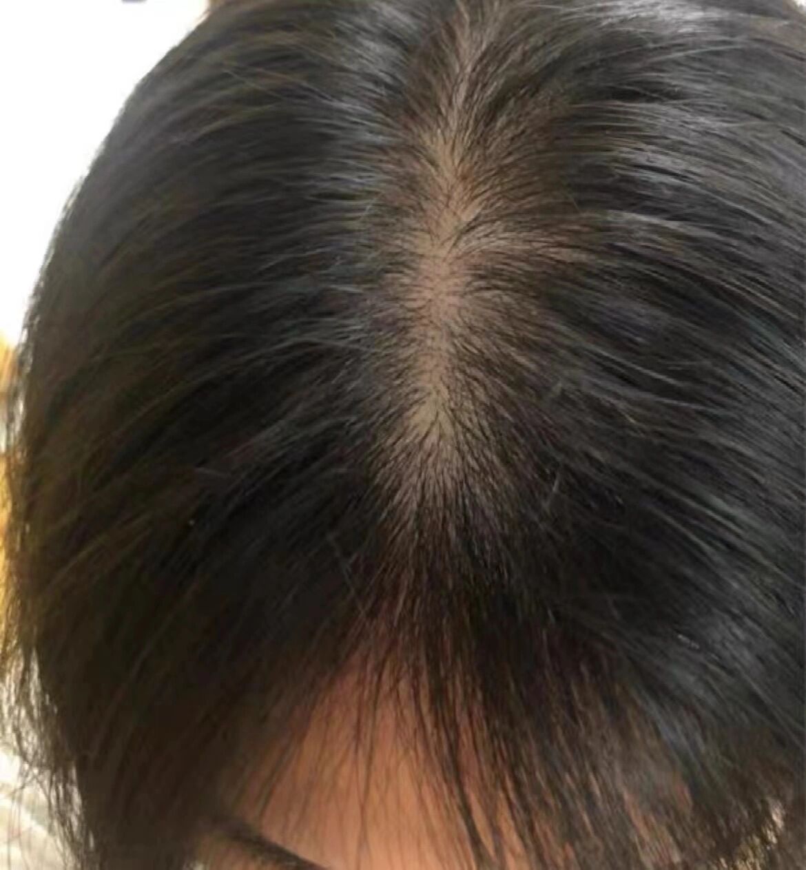 毛囊克隆治愈了我的遗传性秃顶