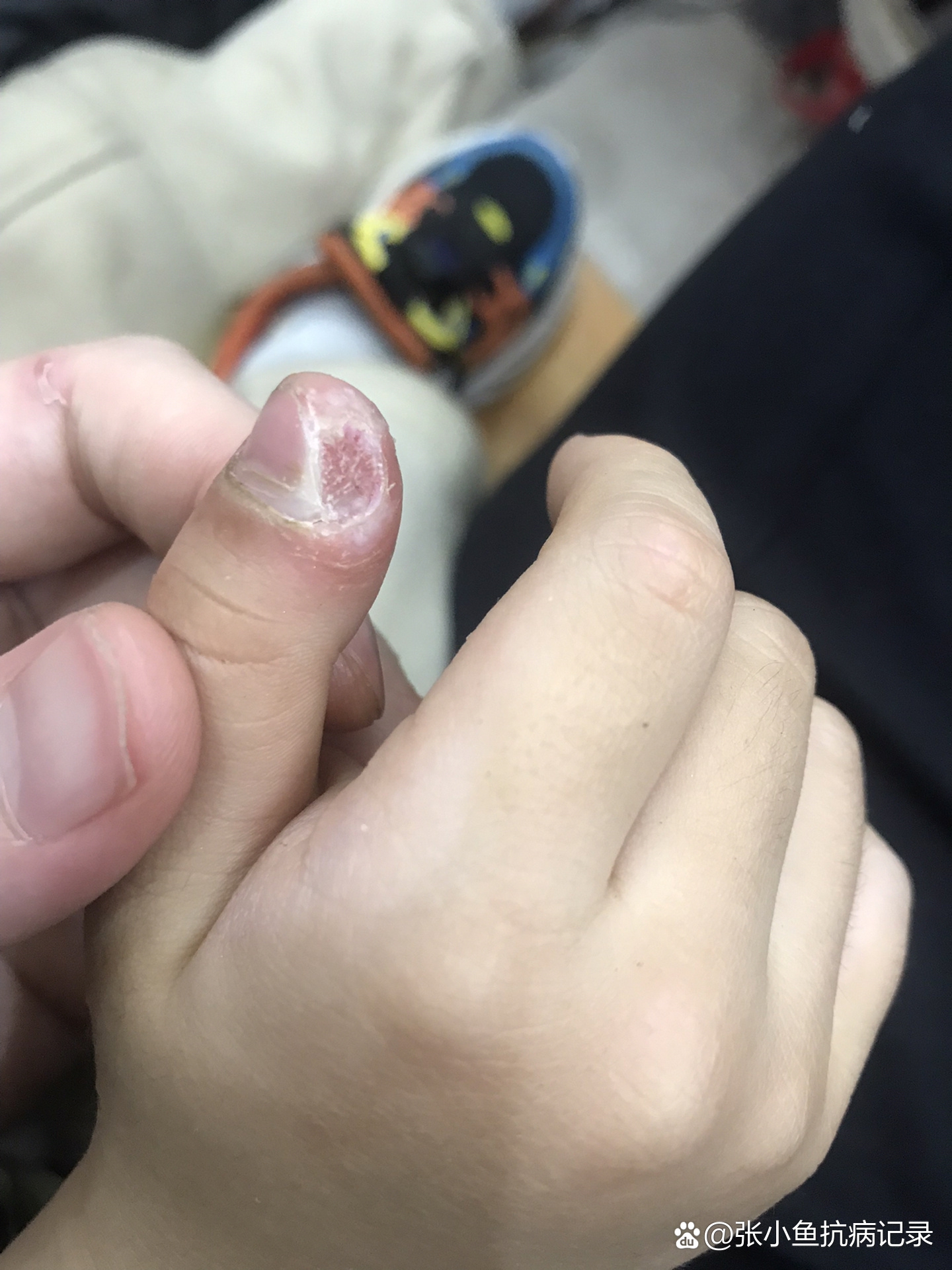 甲周疣治疗第十一天