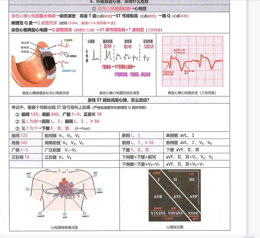 中医规培结业考核之急性心梗定位及理解