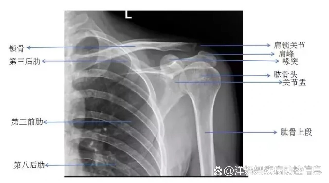 肩关节简单解剖及骨折表现