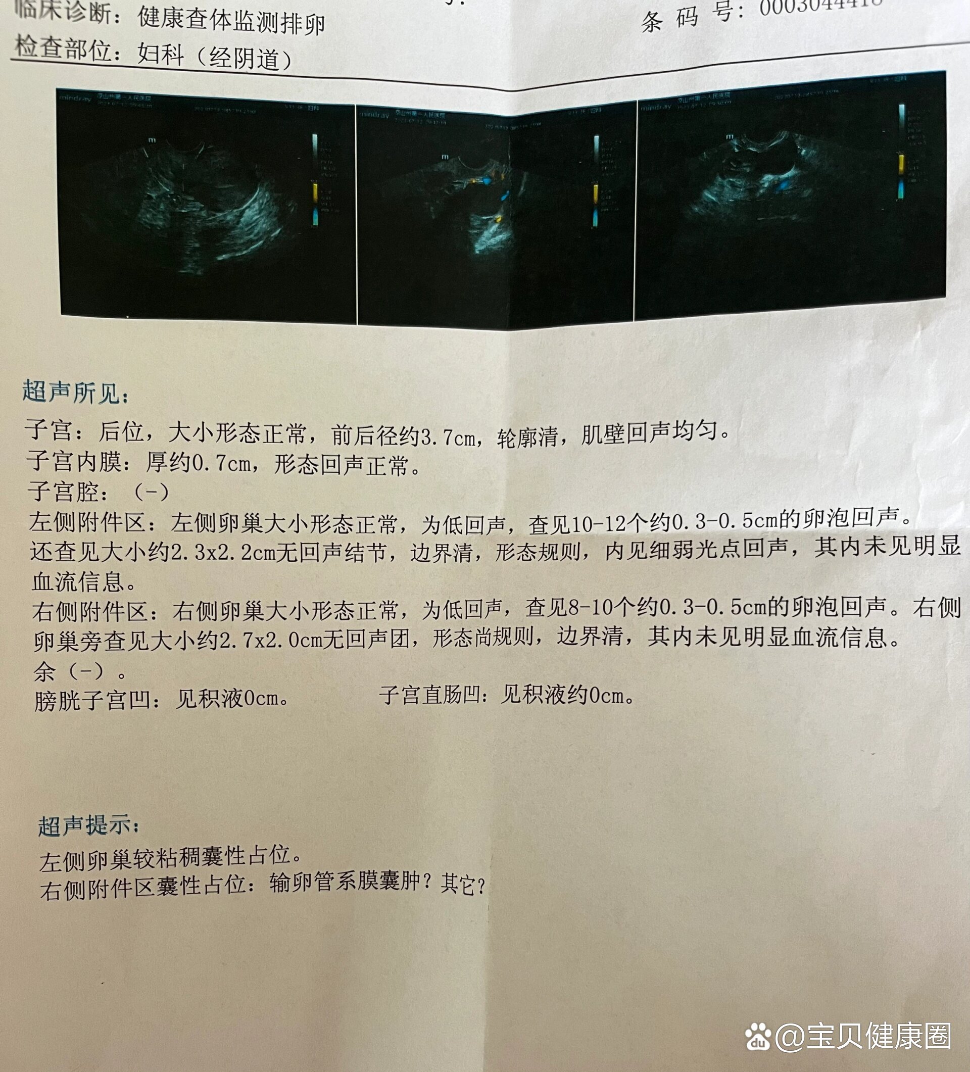 月经第16天卵泡监测