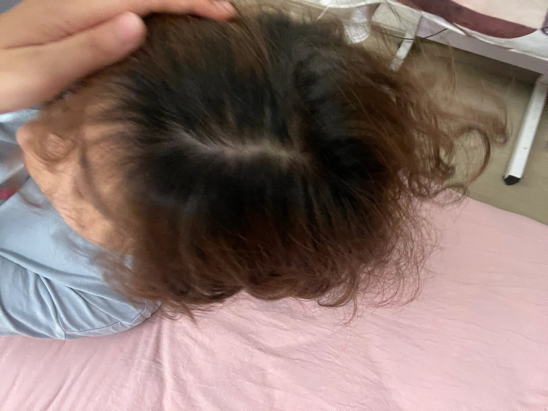 正常人的发缝是多宽