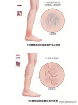 静脉曲张六期图片图片