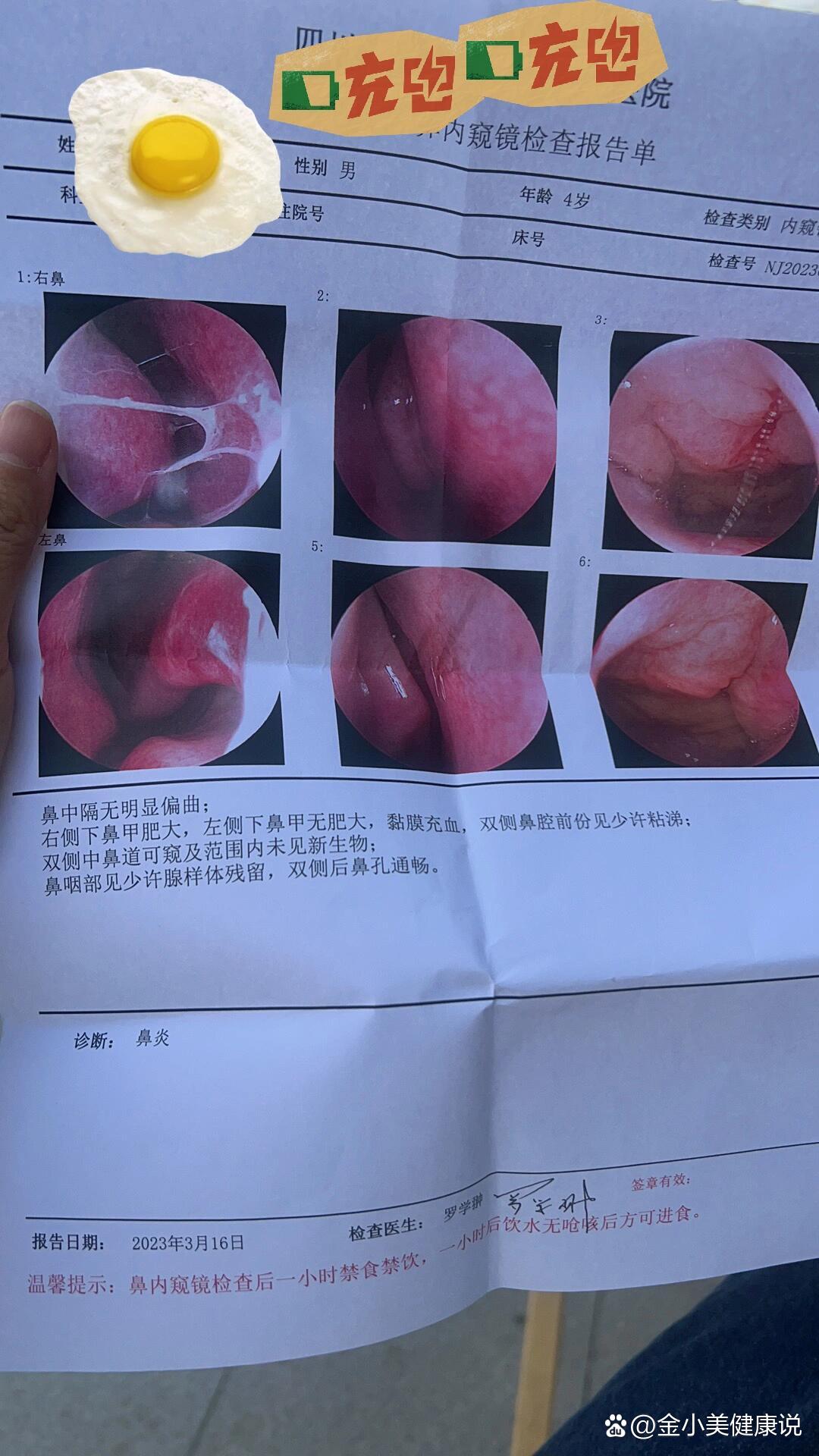 做了腺样体手术鼻窦炎会不会好一点
