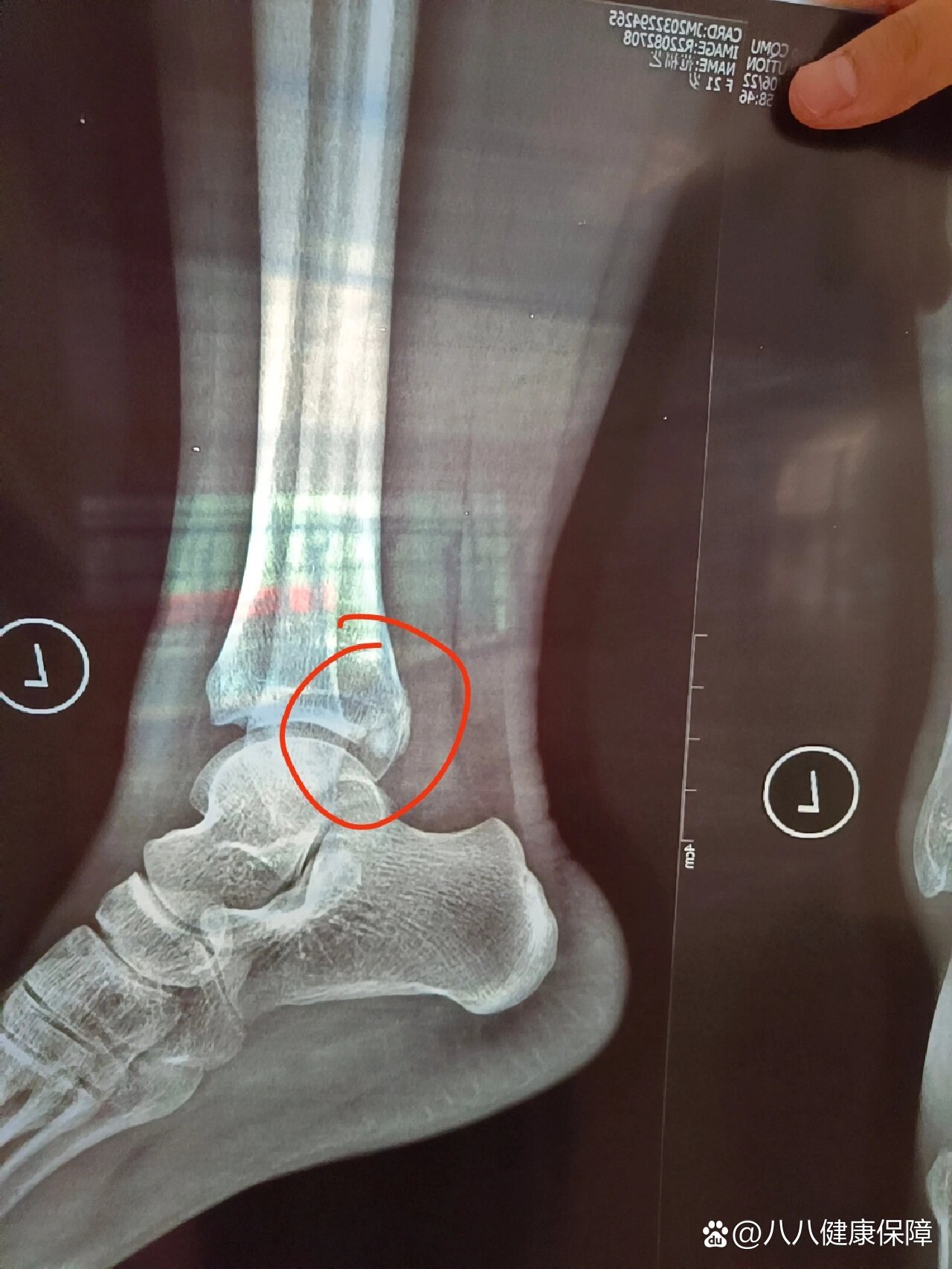 脚后踝骨折32天