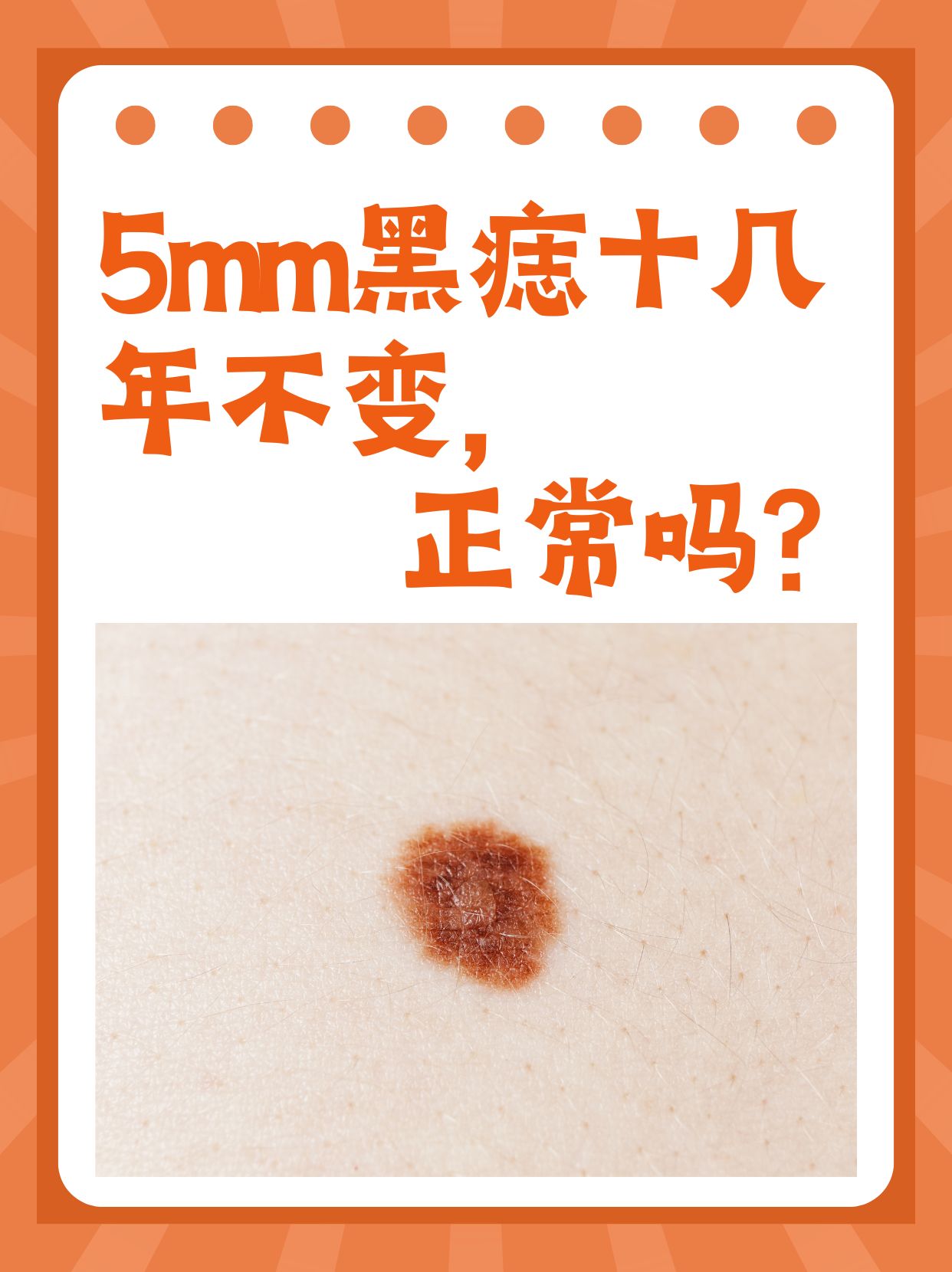 5mm黑痣十几年不变,正常吗?