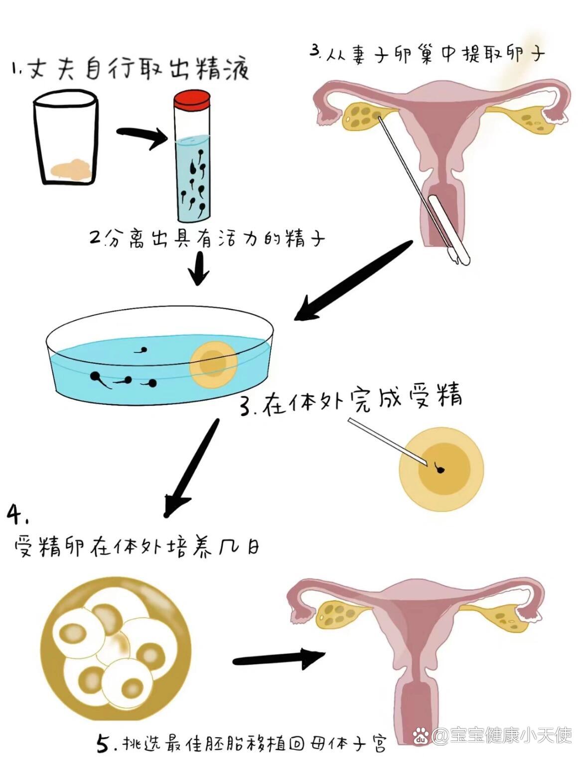 三代试管过程图片