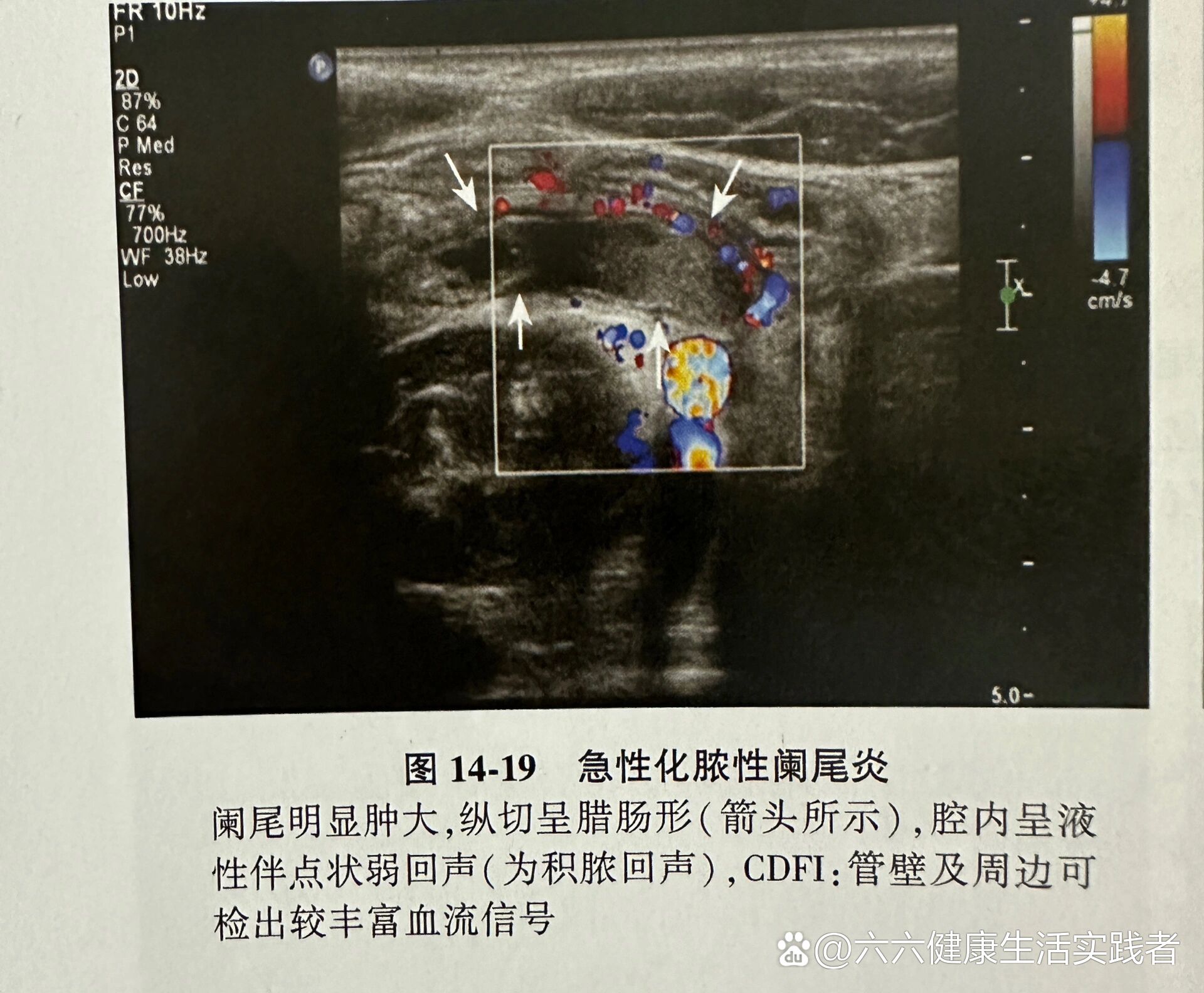 阑尾炎超声图片大全图片