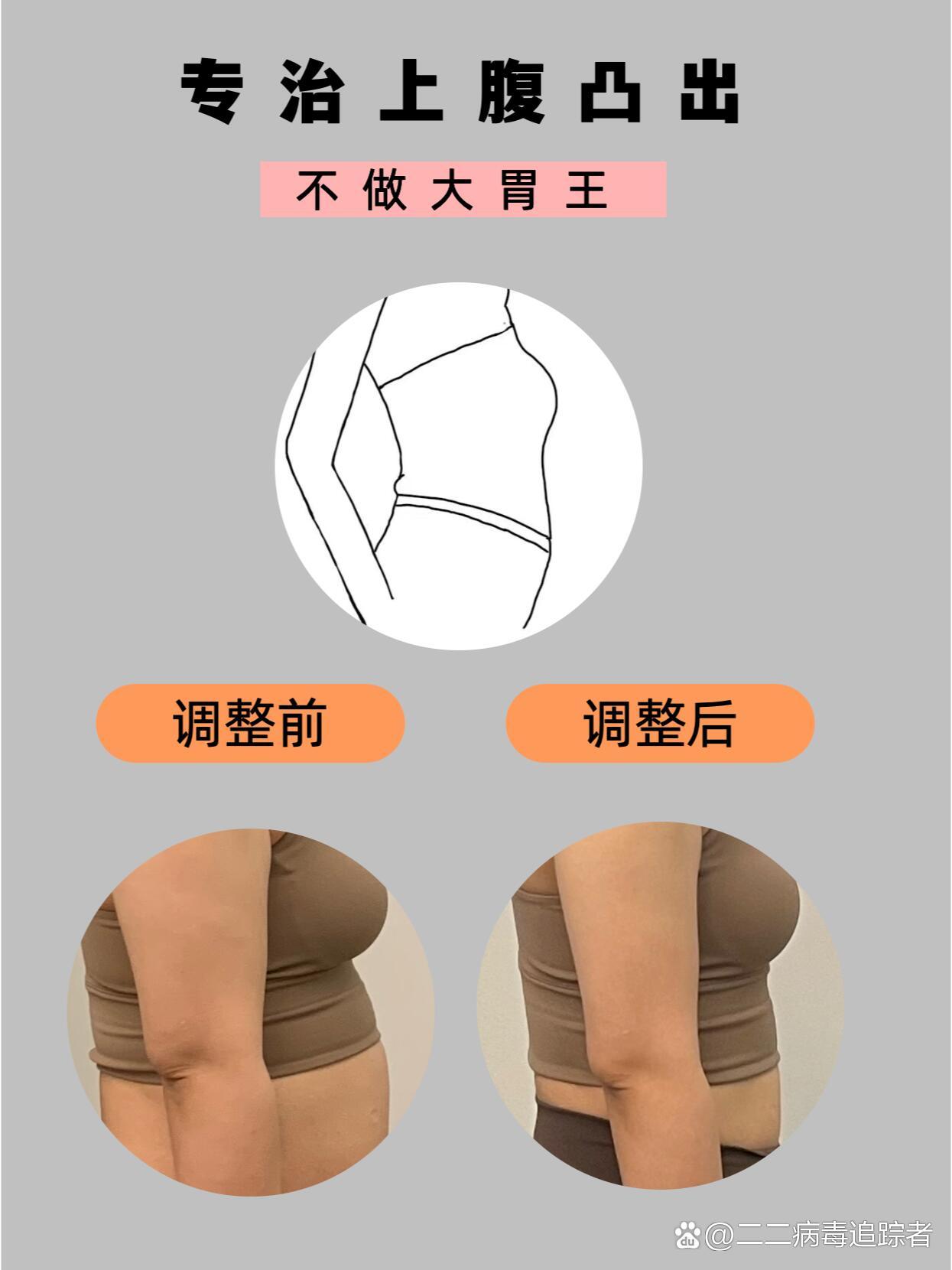 很多人认为上腹突出是吃太多后把胃撑大了,但是胃具有伸缩能力