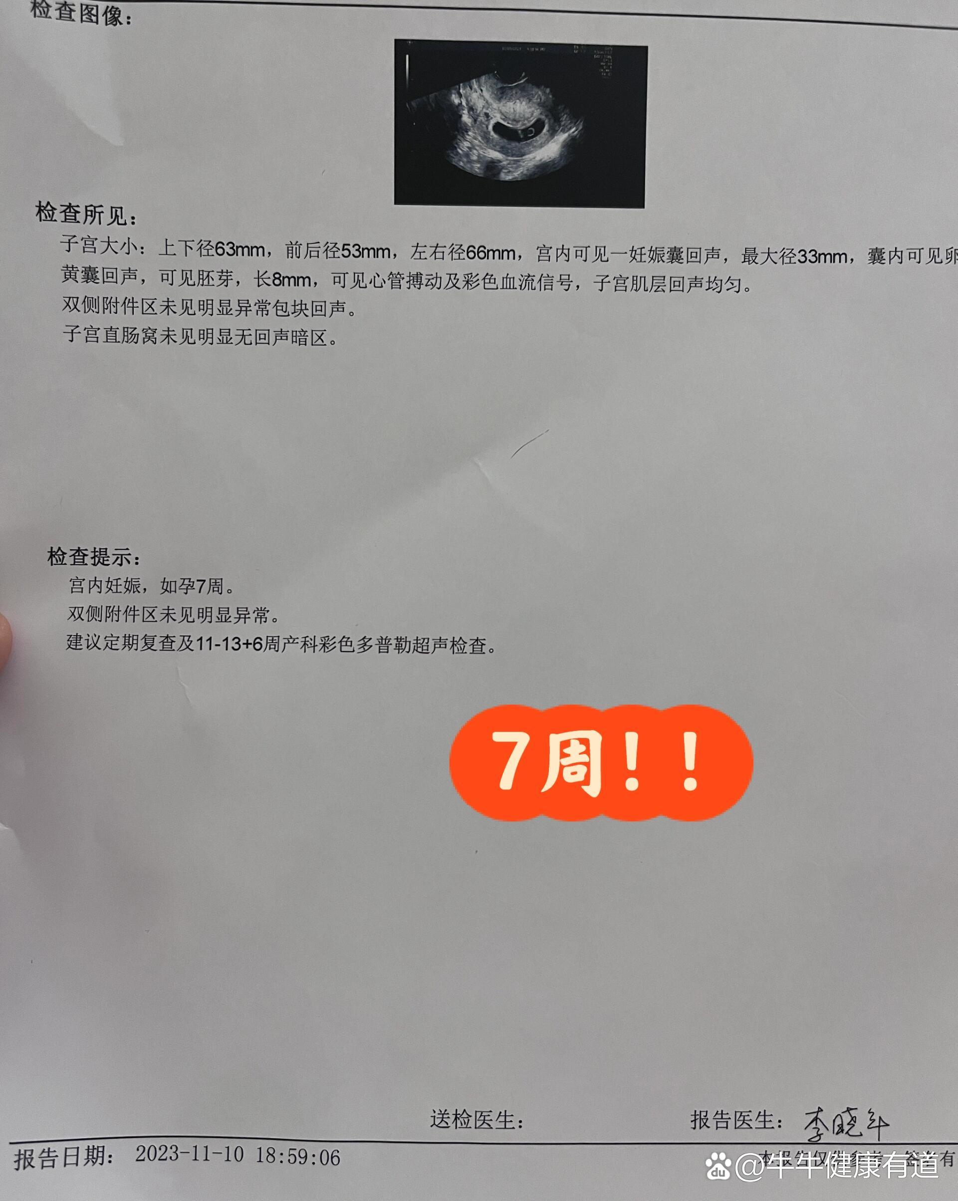 子宫直肠窝无回声区图片