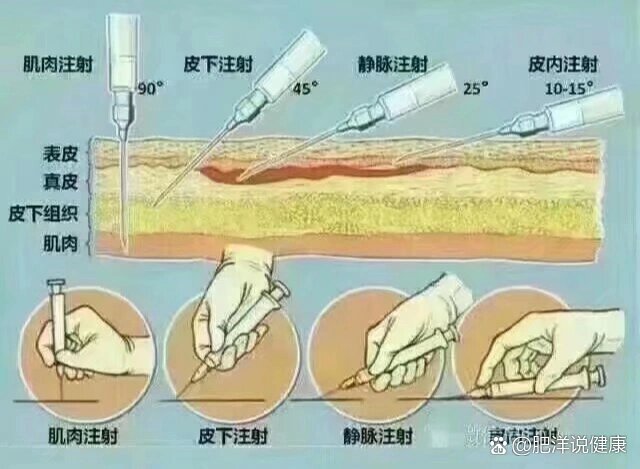 腹腔穿刺术进针图片