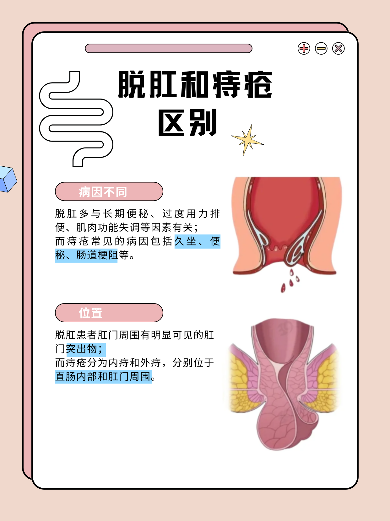 几个方法教你区别脱肛和痔疮