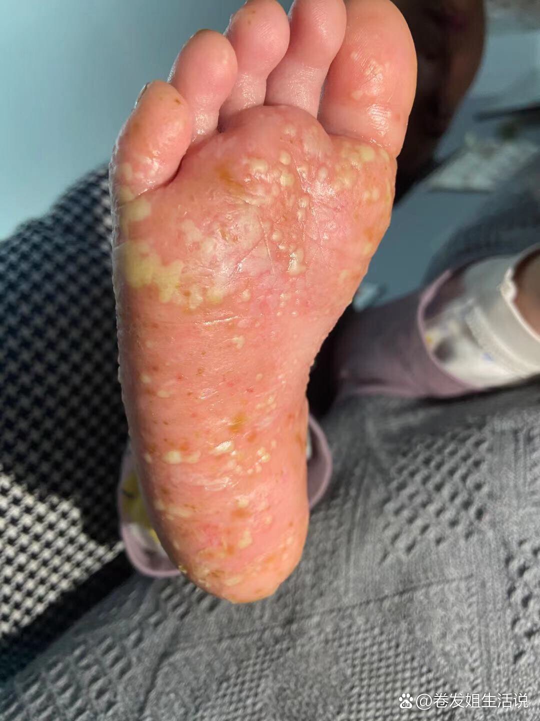 2月7个月的掌跖脓包病患者