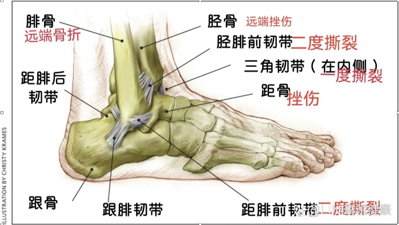 撕脱性骨折第50天