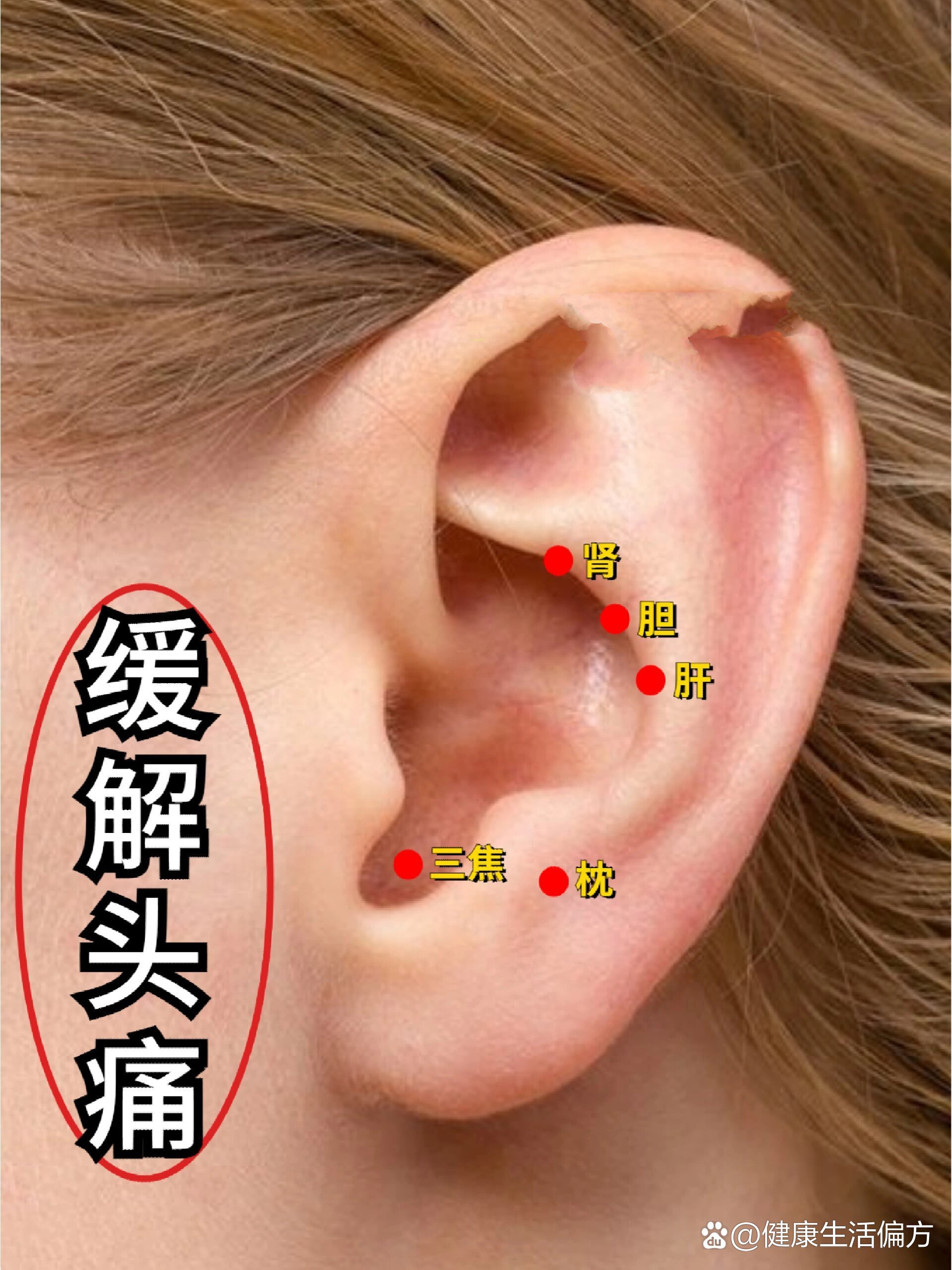 贴豆头疼穴位:👉前额或两侧疼痛:三焦,胆👉头顶疼痛:肝