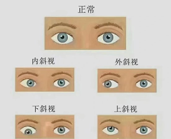 什么是儿童的斜视？