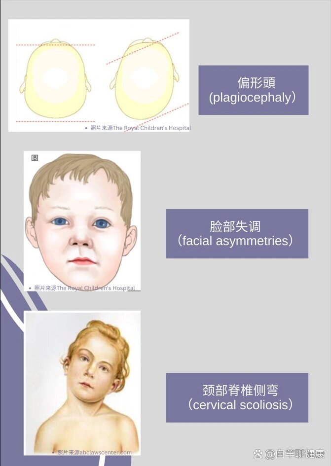 先天性肌斜颈图片图片