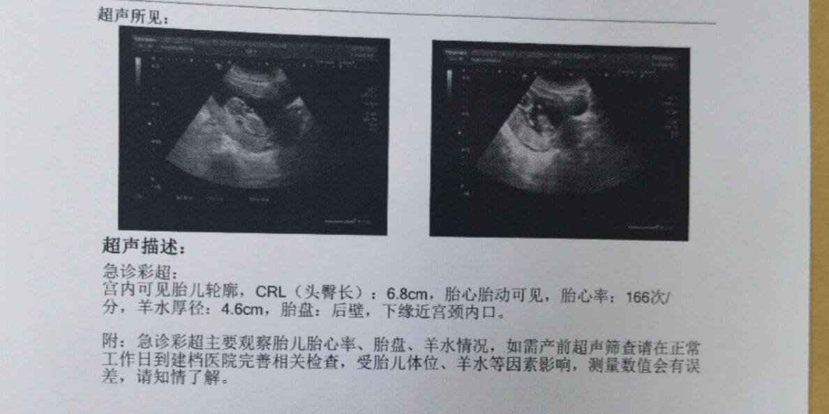 孕13周胎儿胎心位置图图片