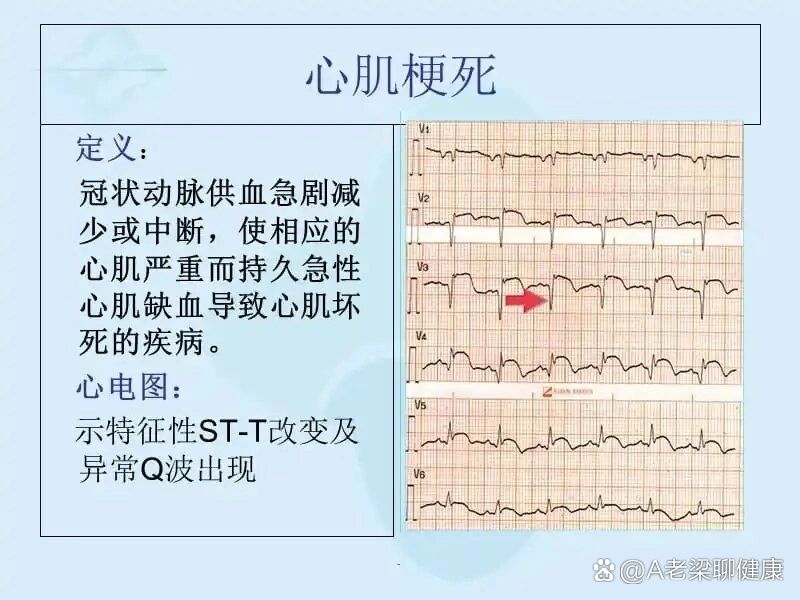 心梗三项图片