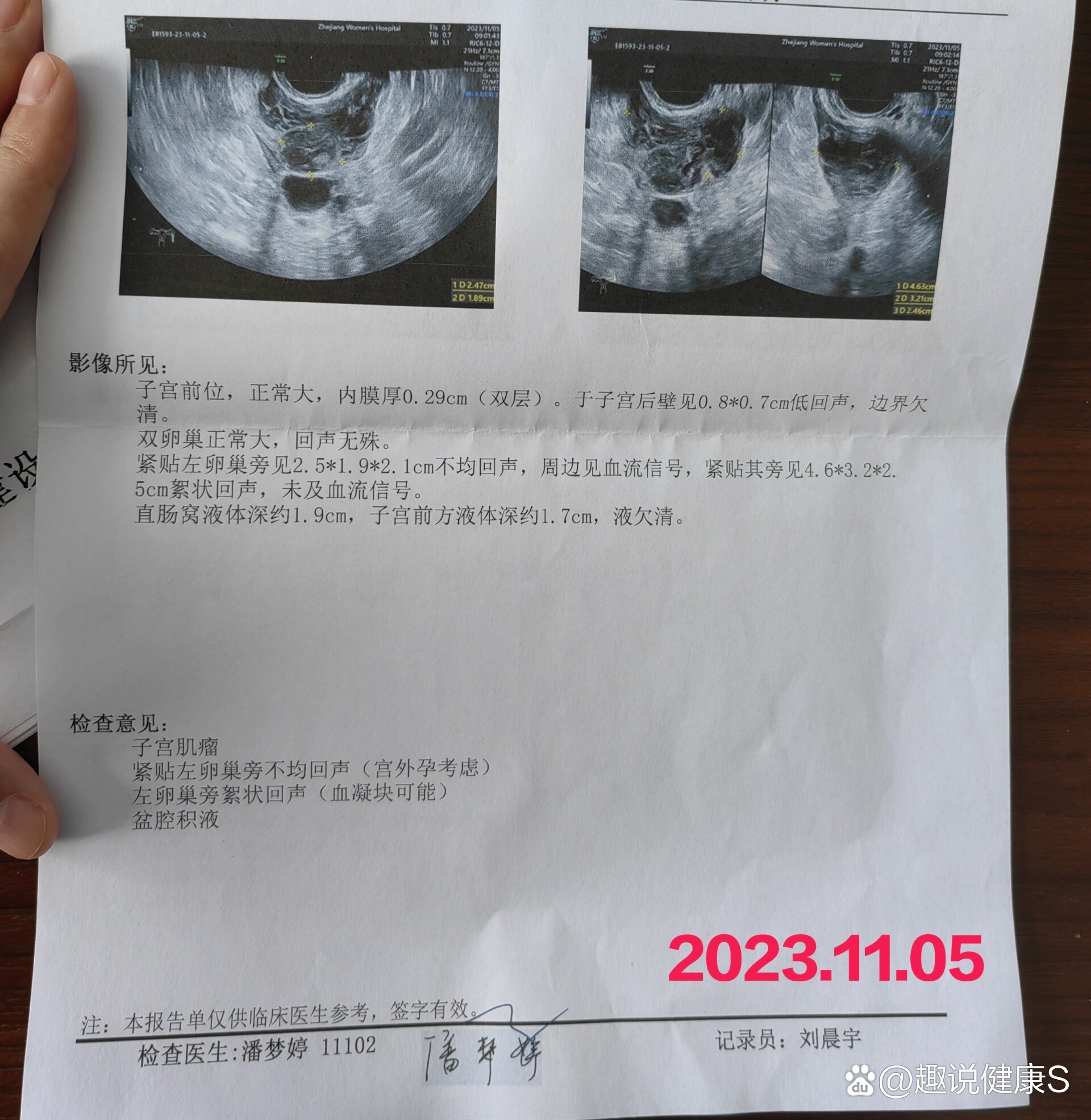 宫外孕保守治疗第38天