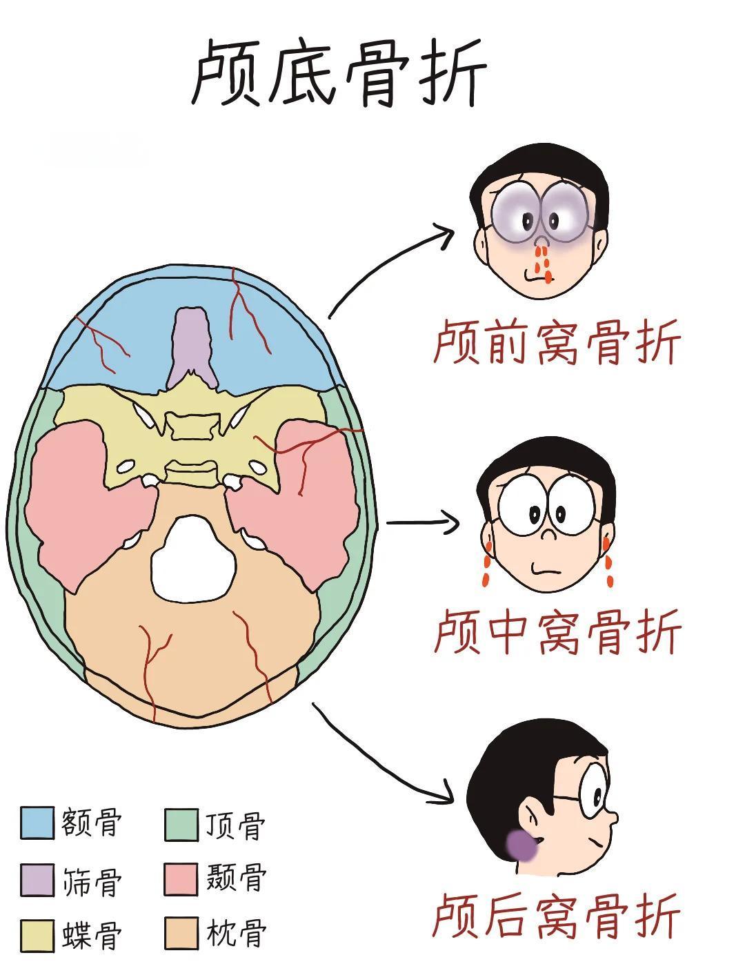 颅底骨折的那些事儿💥