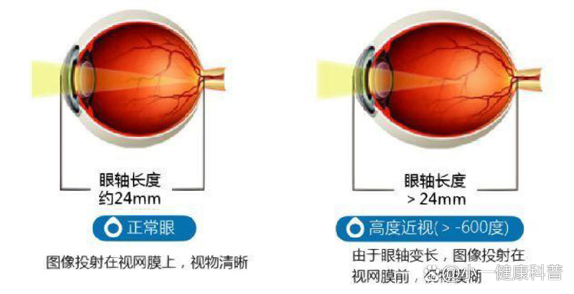 眼睛近视原理图图片