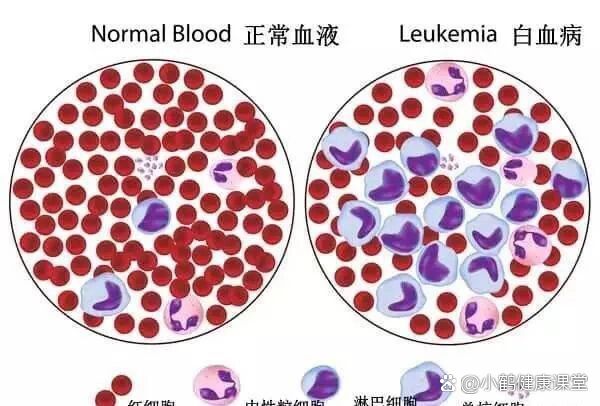 mds通常不是白血病,但是属也属于血液病的一种,通常恶性程度也比较高