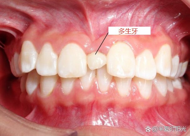 门牙长一颗多生牙,是不是不能拔?