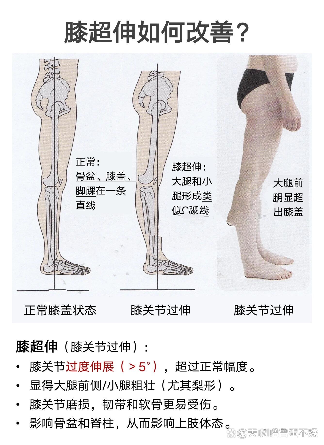 膝超伸的原因和改善思路