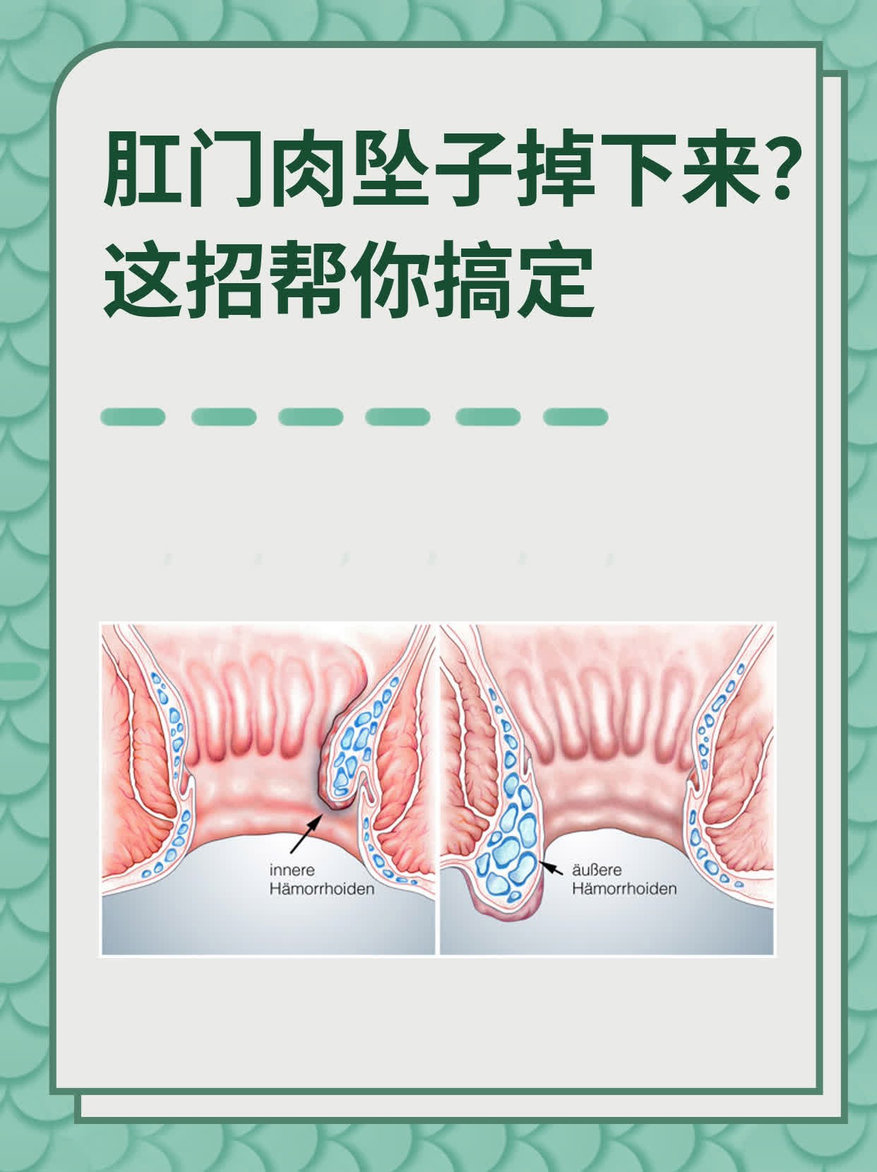 肛门处长白色颗粒图片