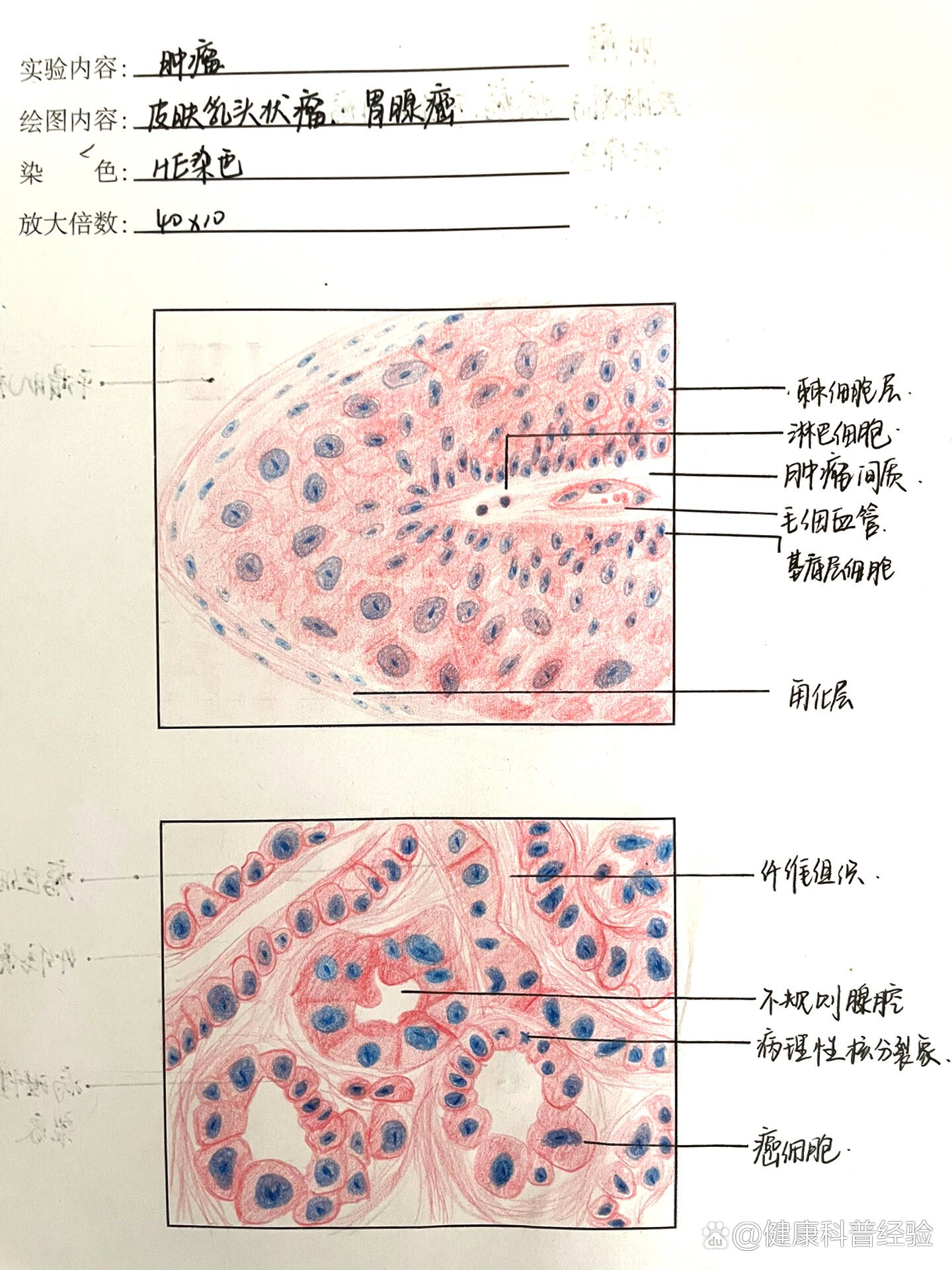 绒毛膜癌病理手绘图图片