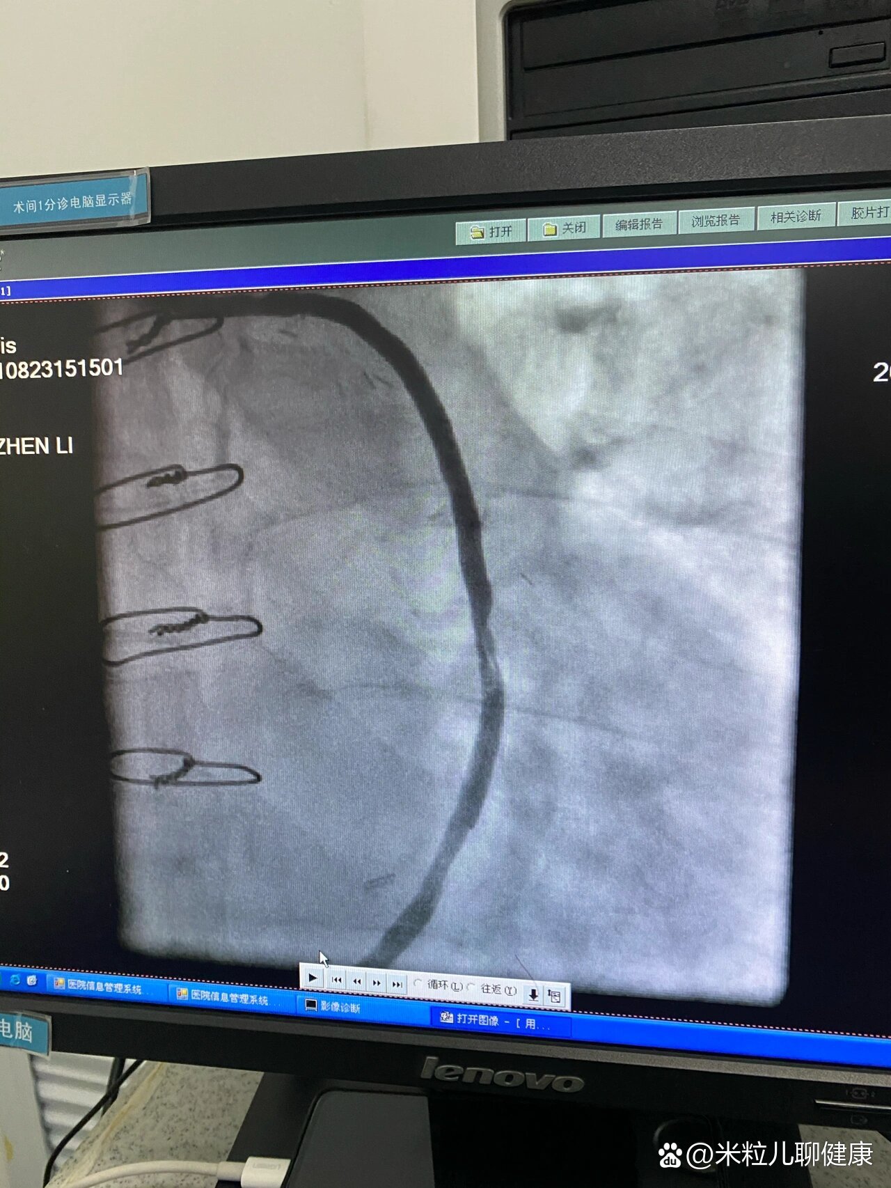冠脉搭桥术后13年静脉桥血管闭塞急性心梗