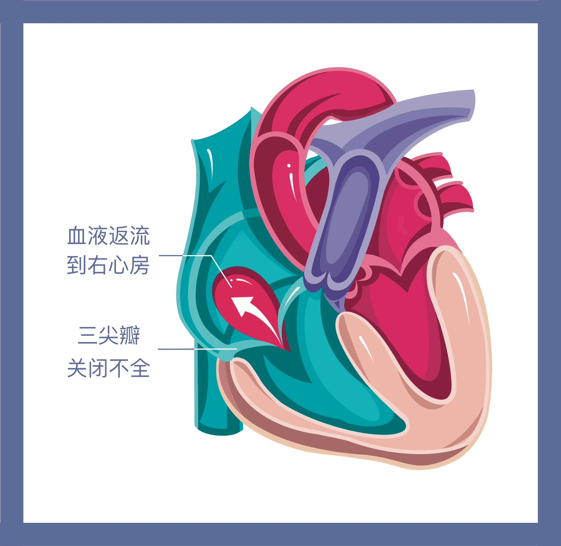 三尖瓣隔瓣图片