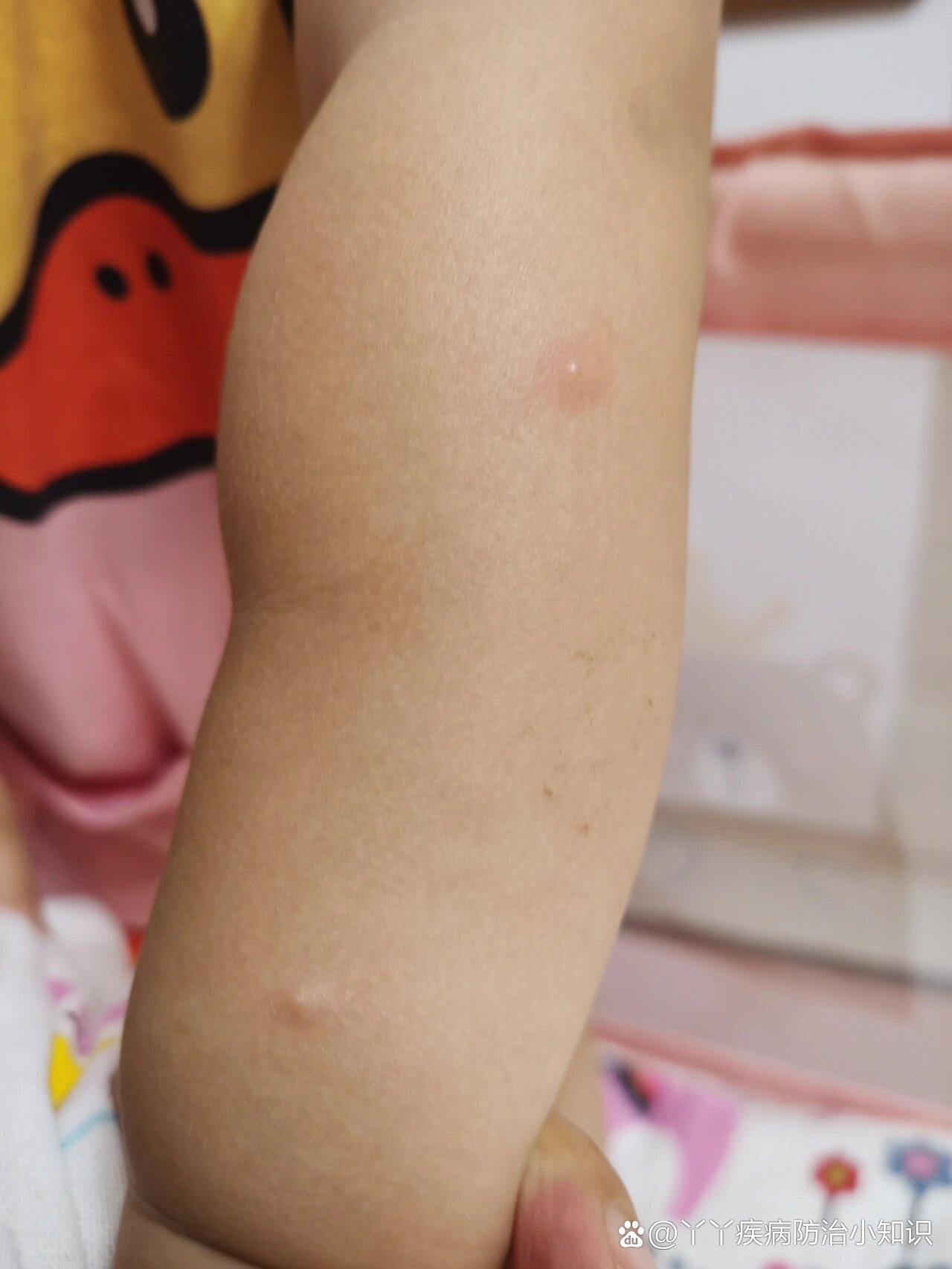 两岁宝宝吃螃蟹过敏了?