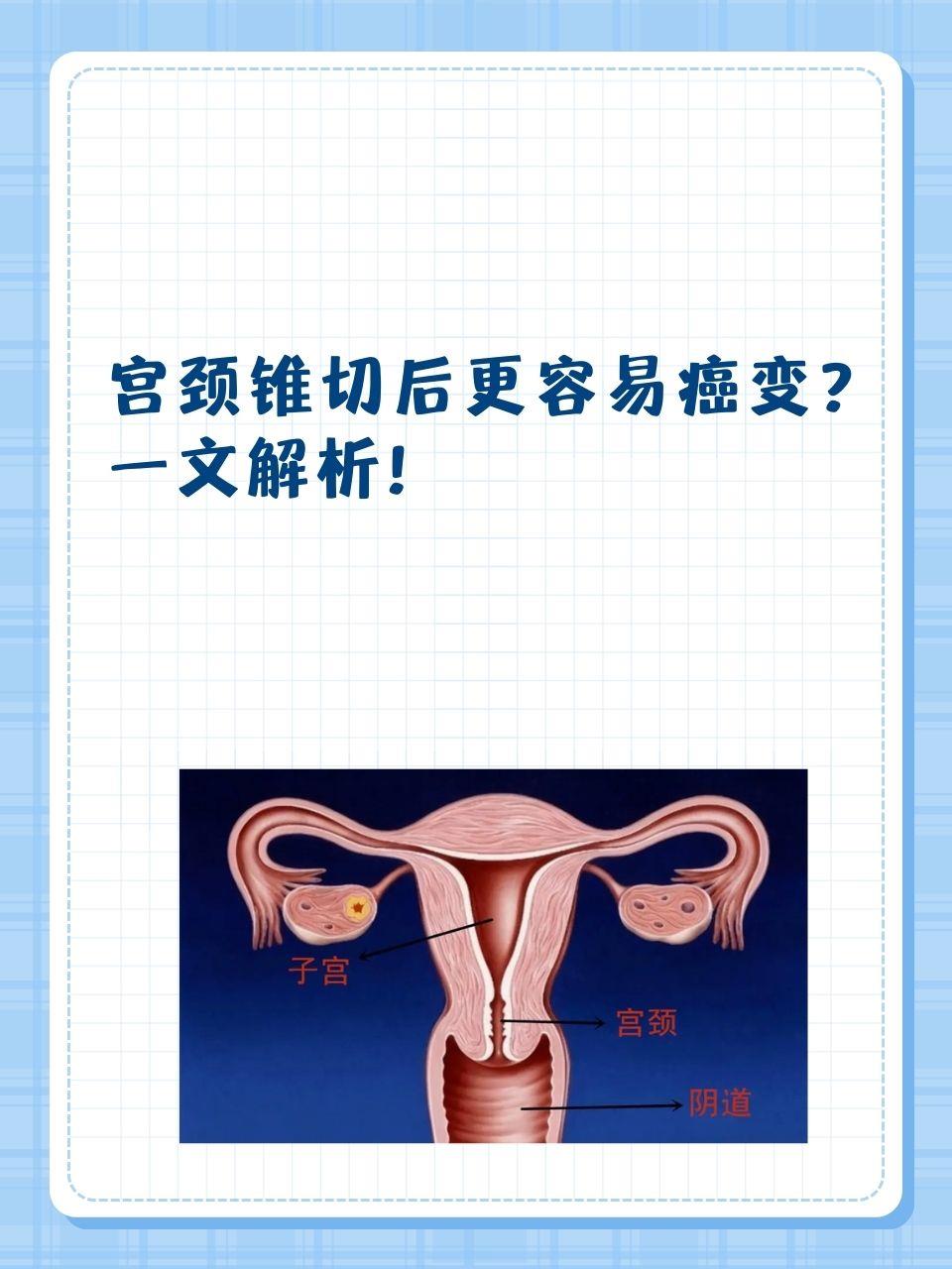 宫颈锥切后更容易癌变?一文解析!