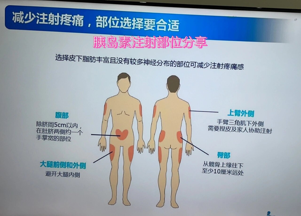 胰岛素注射部位分享
