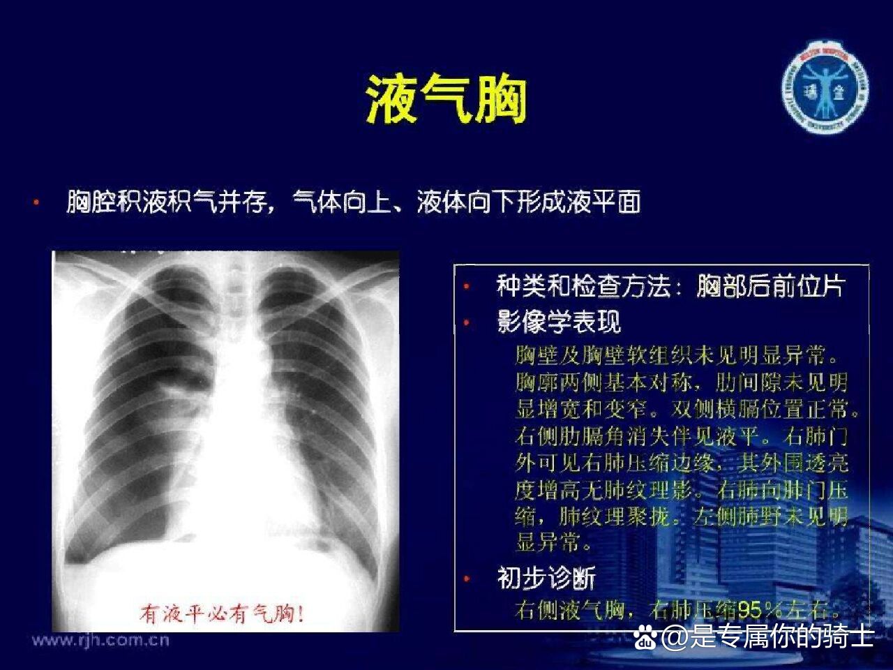 肺部气液平面图片